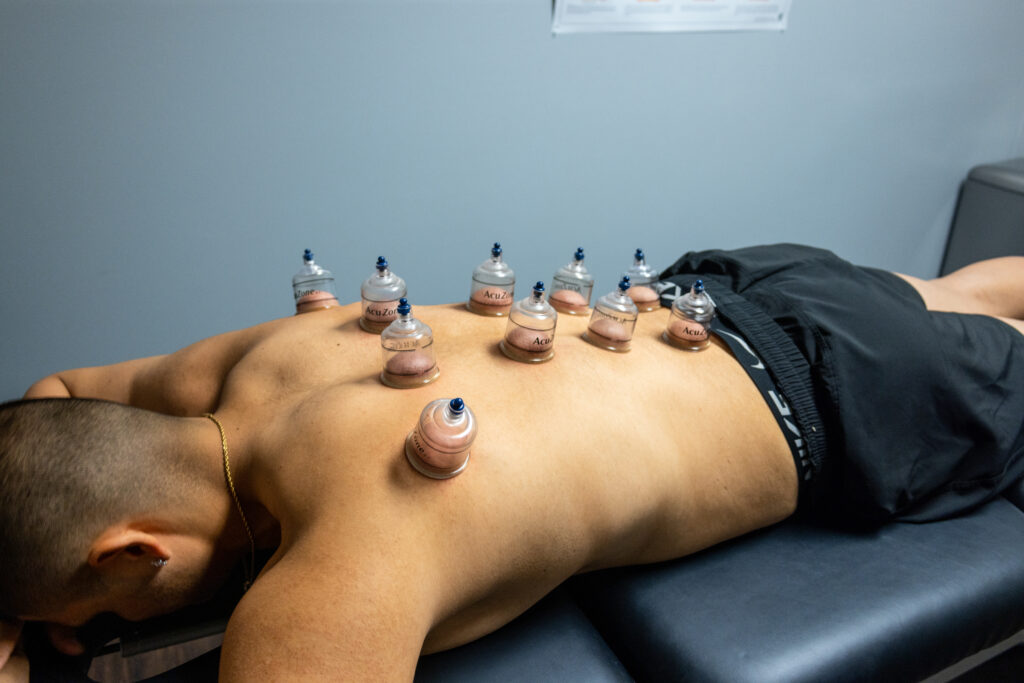 cupping