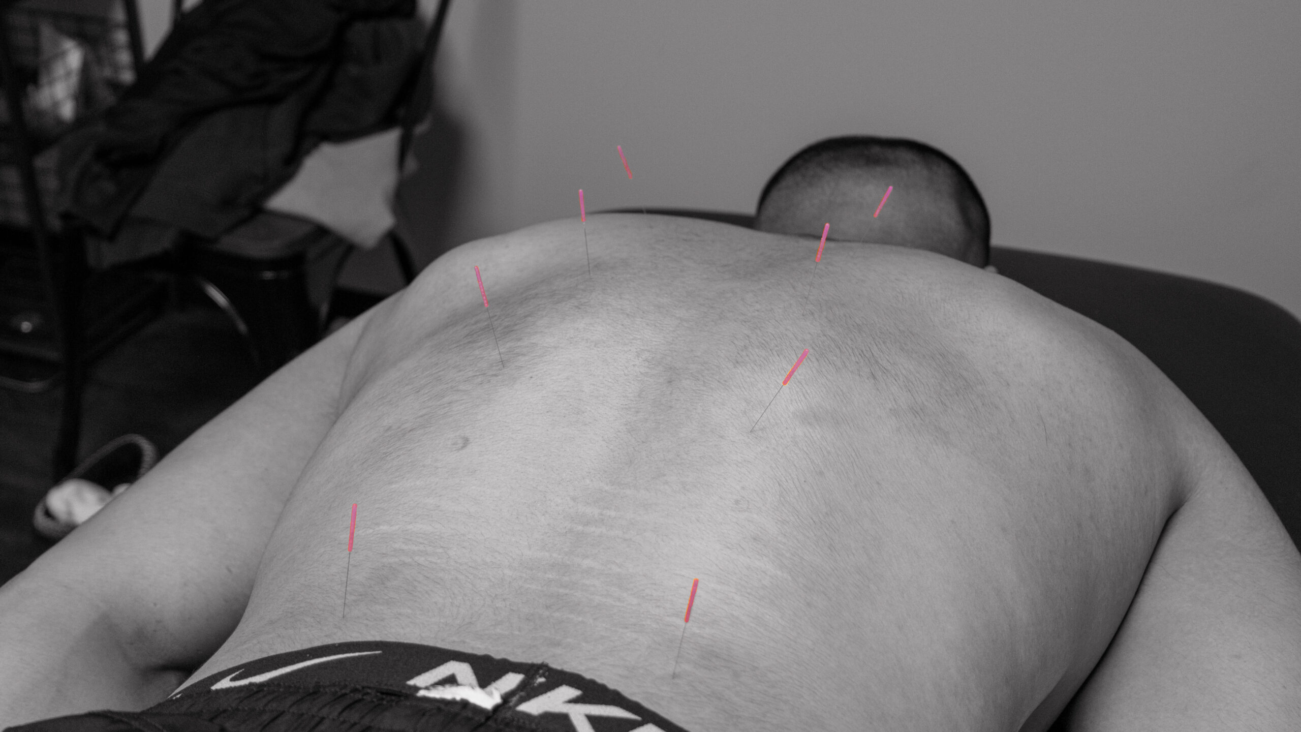 acupuncture